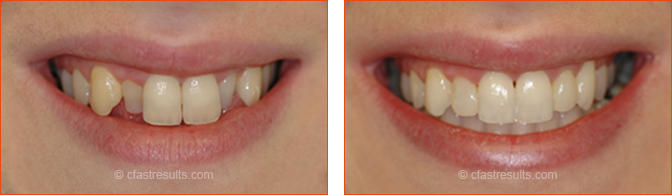 Cfast Smile tru in Essex