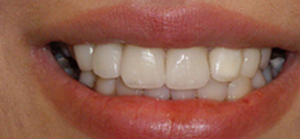 veneers ilford